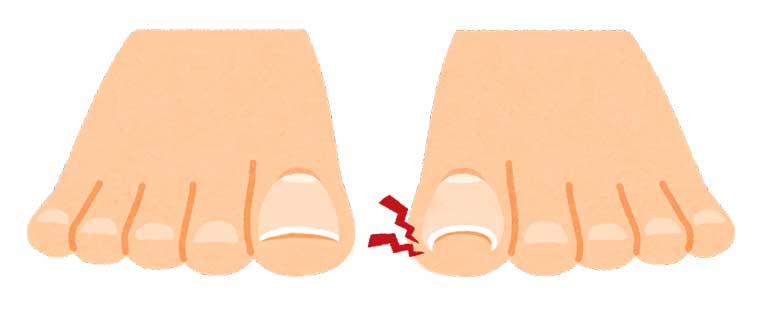 足の親指の爪の横が痛い方