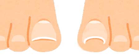 足の親指の爪の横が痛い方の爪の形を比較