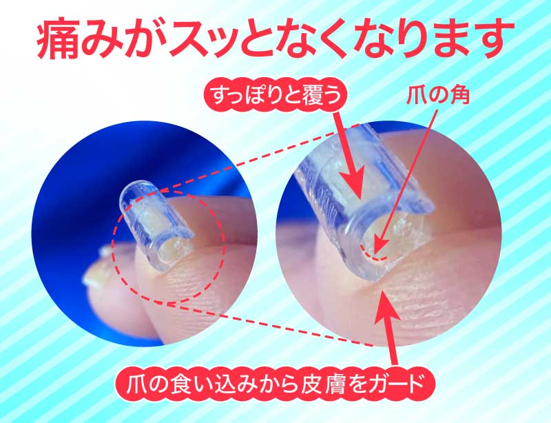 巻き爪の痛みの応急処置