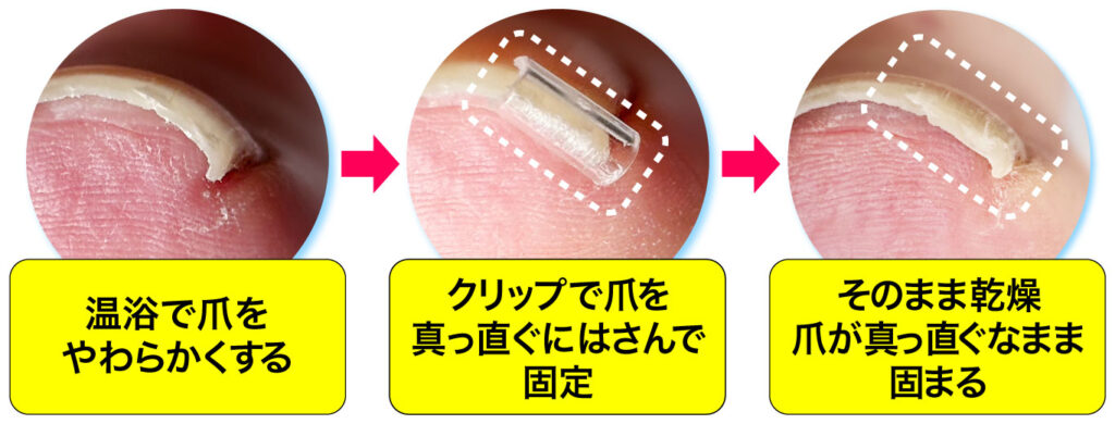巻き爪矯正で爪を平らに