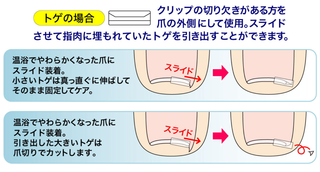 巻き爪のトゲをケア
